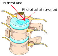 Mechanical Low Back Pain