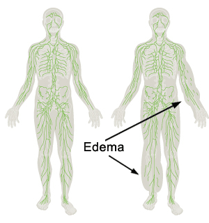 Lymphedema