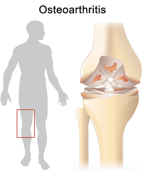 Knee Osteoarthritis (OA) Process