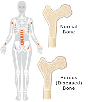 Osteoporosis