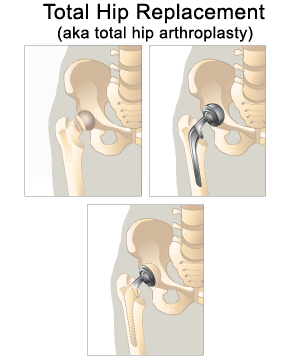 Hip Replacement or Total Hip Arthroplasty