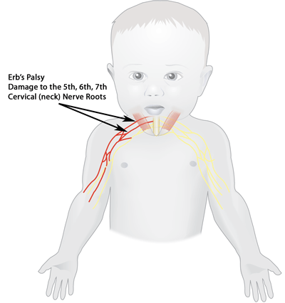 Erbs_Palsy (32K)