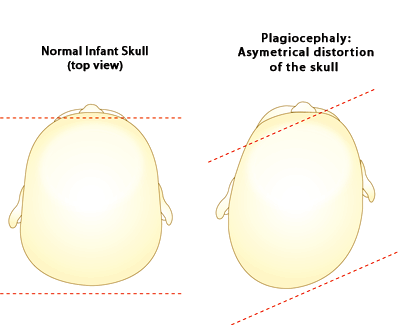Plagiocephaly (17K)