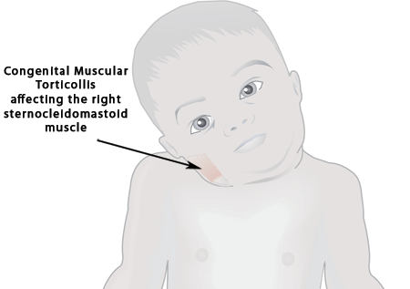 Torticollis (23K)