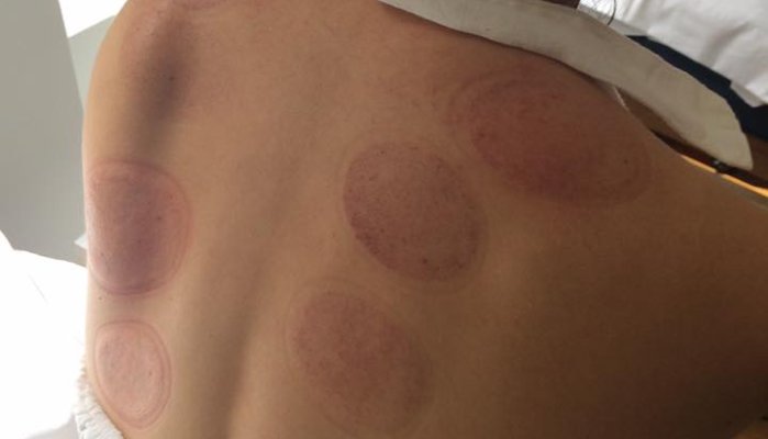 Dynamic Physical Therapy | Cupping