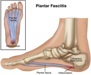 physical therapy for plantar fascia