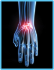 Arthritis