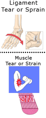 sprains and strains