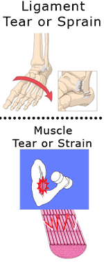 Sprains & Strains - Port Jefferson Physical Therapy - Huntington and Port  Jefferson NY