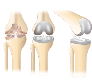 knee-replacement (36K)