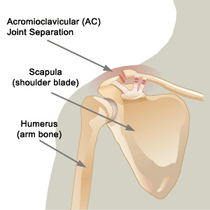 Separated Shoulder or Acromioclavicular Separation