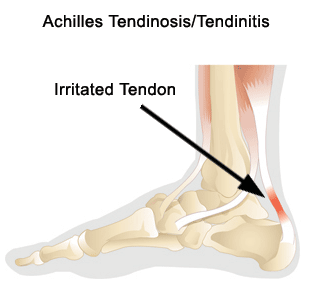 Achilles Tendonitis