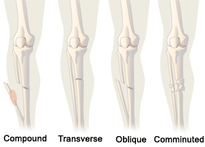 Leg Fractures