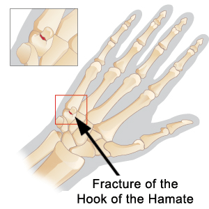 Hook deals of hamate