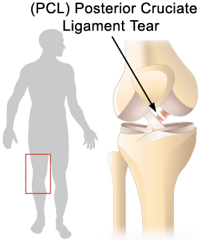 Medial collateral ligament injury: MedlinePlus Medical Encyclopedia Image