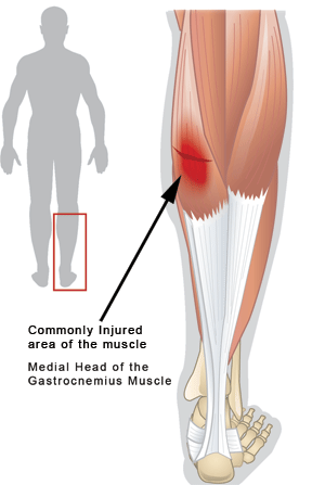 Gastrocnemius/Calf Muscle Strain