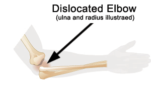 Fracture/Dislocated Elbow