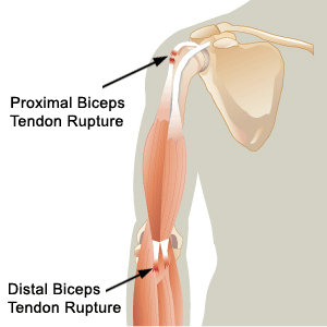 Biceps and Triceps Tendon Rupture – Core EM