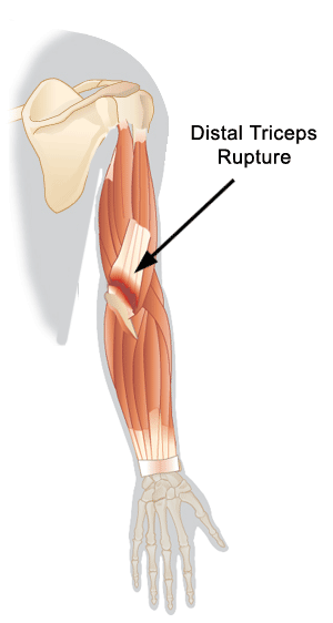 Triceps injury