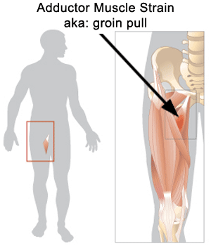 How to Treat a Groin Strain