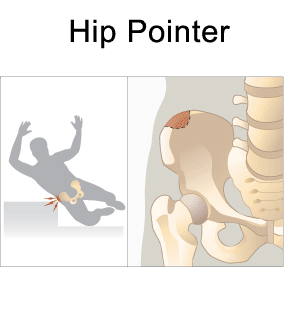 Hip Pointers and Trochanteric Bursitis