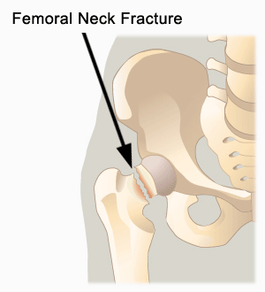 Femoral Neck Fracture Surrey and New Westminster BC : Prana Physio