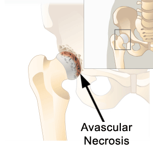 Avascular Necrosis of the Hip