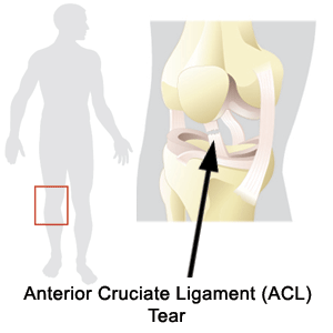 Anterior Cruciate Ligament (ACL) Tear Eugene OR : Reclaim Physical Therapy