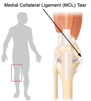 Medial Collateral Ligament (MCL) Tear