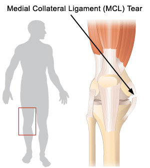 MCL Tear or Medial Collateral Ligament Injuries