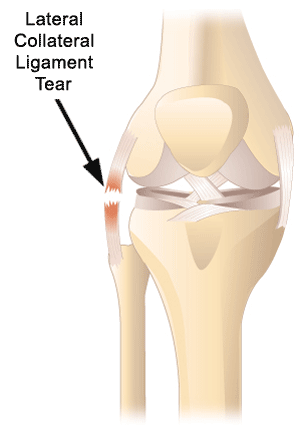 How to diagnose and treat a medial collateral ligament and lateral