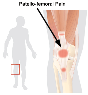 Patello-femoral Pain (Commonly Called Chondromalacia Patella) Surrey and New  Westminster BC : Prana Physio