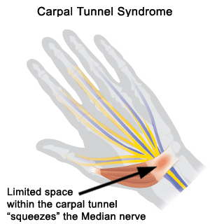 Carpal Tunnel Syndrome Midtown East NY : High Performance PT