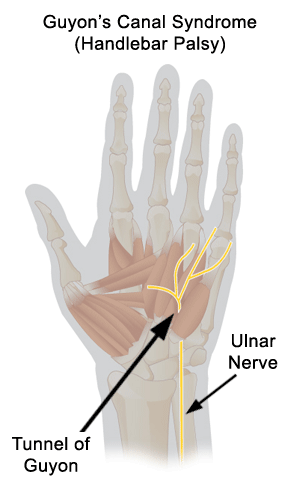 Ulnar Nerve Compression in Guyon's Canal