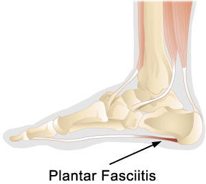 Plantar Fasciitis physiotherapy Oakville ON : Eq Physio