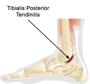 Tibialis Posterior Tendonitis