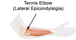 Tennis Elbow (Lateral Epicondylalgia)