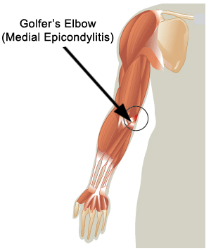 Golfers Elbow (Medial Epicondylitis)