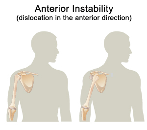 Shoulder Instability