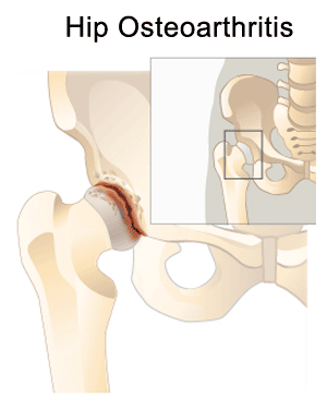 Avascular Necrosis of the Hip