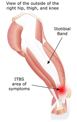Iliotibial Band Syndrome (ITBS), Texas: Symptoms & Treatment