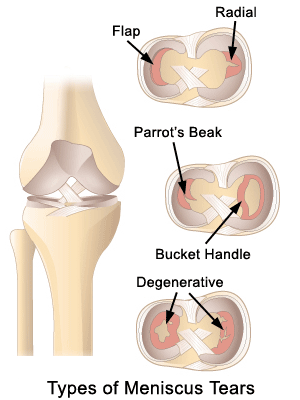 Medial collateral ligament injury: MedlinePlus Medical