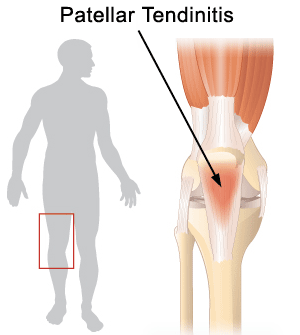 Patella Tendinopathy (also known as “Jumper's Knee”)