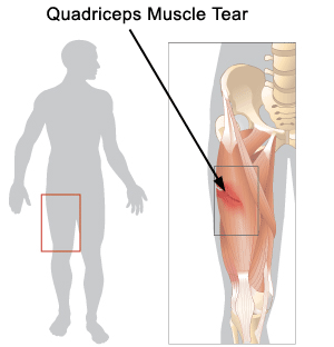 Quadriceps Muscle Strains Midtown East NY : High Performance PT