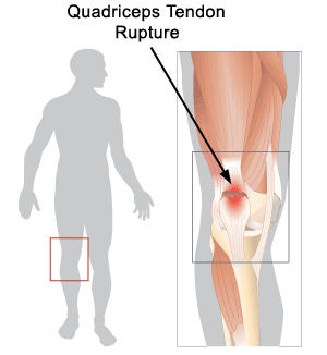 Quadriceps Tendon Rupture Eugene OR : Reclaim Physical Therapy