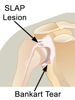 Labral Tear