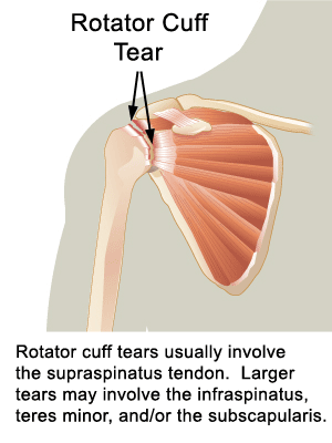Rotator cuff tears usually involve the supraspinatus tendon> Larger tears may involve the infraspinatus, teres minor and/or the subscapularis.