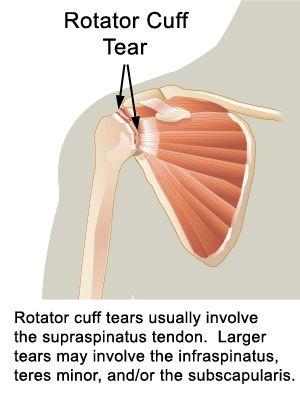 rotator tear symptoms