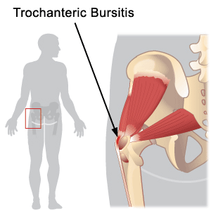 Hip Pointers and Trochanteric Bursitis