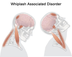 Whiplash Associated Disorder (WAD)